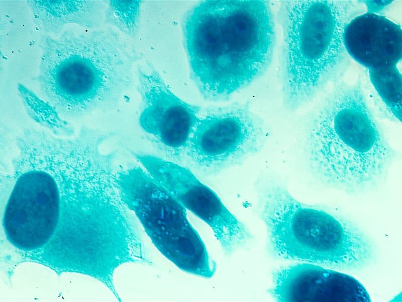 Detección de cáncer de próstata en Vilagarcía